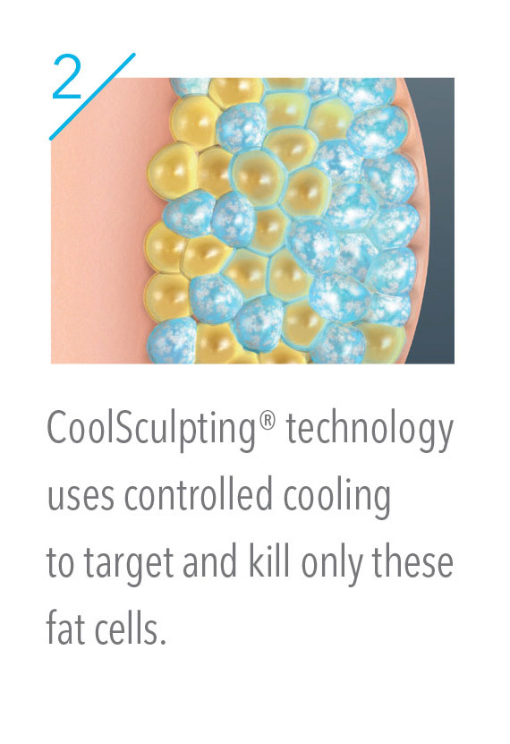 CoolSculpting controlled cooling to target and kill fat cells