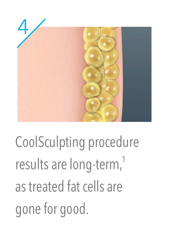 CoolSculpting fat cells are gone for good