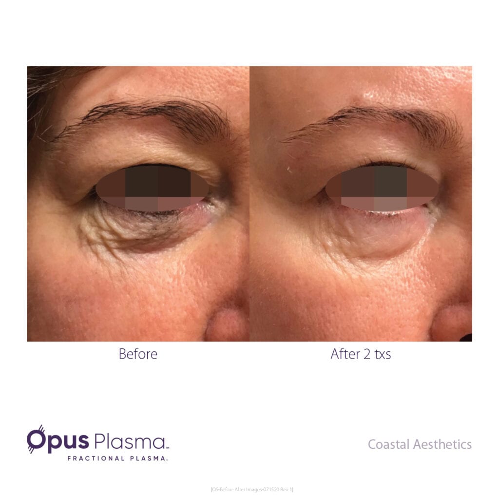 Opus plasma before and after eye
